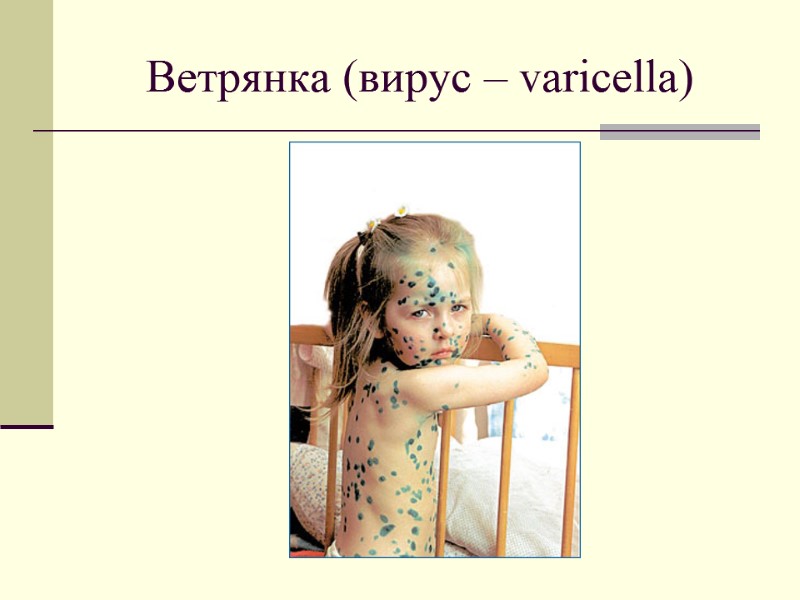 Ветрянка (вирус – varicella)